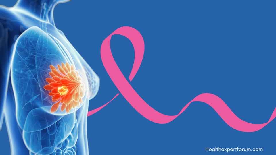 Health Expert Forum: Breast Cancer prevention