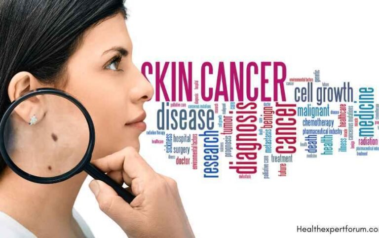 Health Expert Forum Insights: Skin Cancer Symptoms detection on female patient