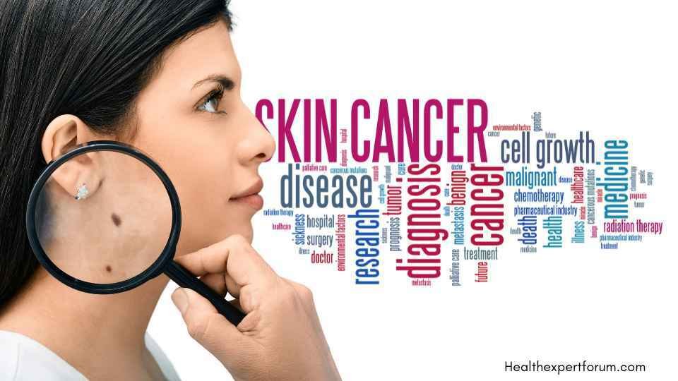 Health Expert Forum Insights: Skin Cancer Symptoms detection on female patient